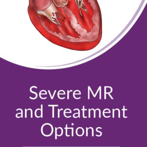 Severe Mitral Regurgitation and Treatment Options